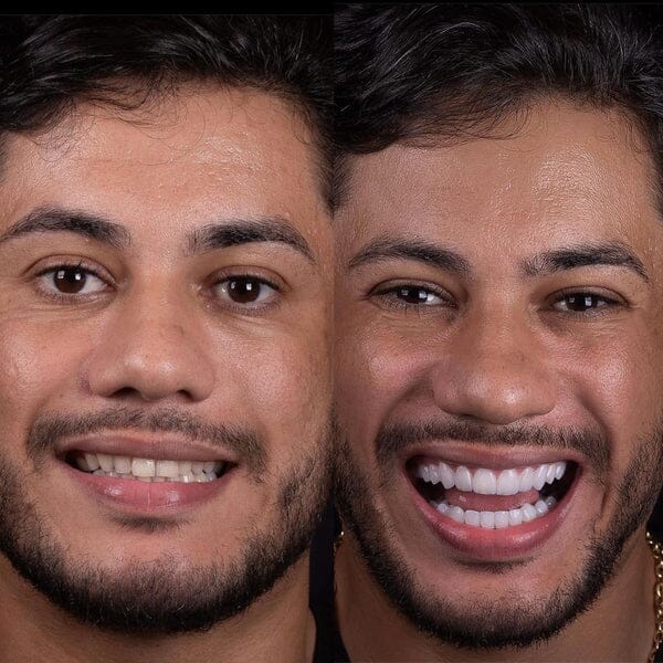 Facetas Odontológicas Removíveis Saude & Beleza (Facetas Odontológicas 1) Dm Stores